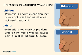 Image result for paraphimosis
