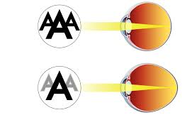 Rite aid #04399 west bloomfield. Myopia Management Pediatric Eye Care In Birmingham Mi