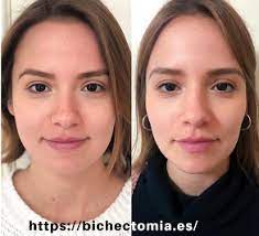 Te invito a visitar mi perfil y a generar una consulta para brindarte toda la información que necesites sobre la bichectomia. Cuanto Cuesta Adelgazar Nuestro Rostro