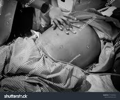 Image result for Shifting Dullness Test