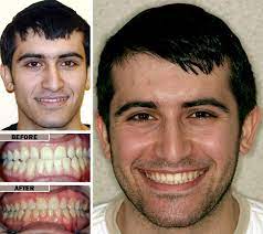 Palate Expander Orthodontic Expander Best Orthodontist In Brooklyn