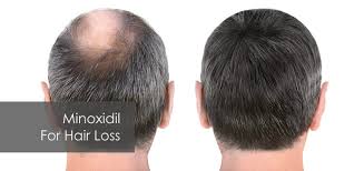 Image result for Minoxidil