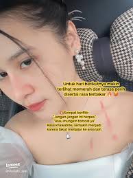 Telur Bau Masam: Punca Herpes & Fakta Penting Yang Anda Perlu Tahu