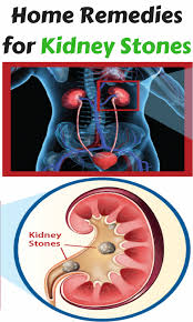 How To Pass Kidney Stones Fast At Home Home Remedies For Kidney Stones Skinwhiteninghomeremedies Ho Home Remedies Kidney Stones Remedy Diy Natural Products