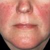 Lupus ban đỏ hệ thống là một bệnh tự miễn. 1