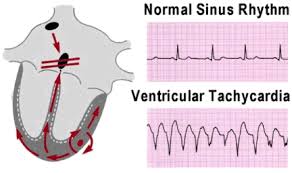 Image result for Ventricular Fibrillation Management in the Adult