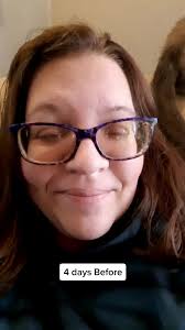 fullteethextraction #dentaljourney 4 days before multi-tooth extracti...