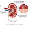It may cause kidney damage, kidney failure, and high blood pressure. 1