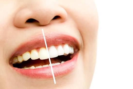 What is Teeth Whitening and Is It Safe?