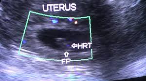 This is not just an ordinary english to nepali dictionary & nepali to english dictionary. Cardiac Flicker In Early Pregnancy By Doppler Youtube