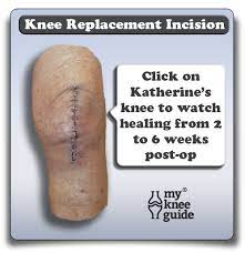 I know that staples are quicker, but i want to minimize this scar. The Wound Important Considerations To Understand
