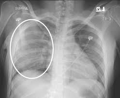 Image result for Pulmonary Contusion