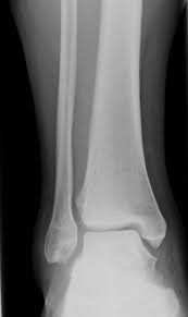 Know the causes, symptoms, treatment and recovery period of maisonneuve fracture. High Ankle Sprain Syndesmosis Injury Foot Ankle Orthobullets