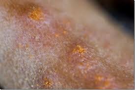 Image result for Trombicula autumnalis bites