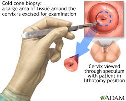 5928 viewsanswered >2 years ago. Cervical Cancer Medlineplus Medical Encyclopedia