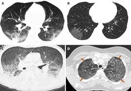 Image result for Pulmonary Contusion