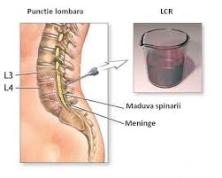 We did not find results for: Scleroza Multipla