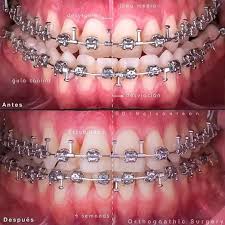 Surgery to pull the upper jaw forward and/or push the lower jaw back. When An Underbite Is Corrected With Braces Is The Jaw Pulled Back Or Are The Teeth Moved Back In The Gums Quora