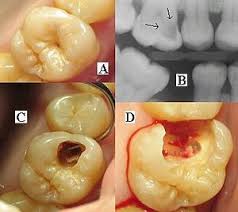 Dental Radiography Wikipedia