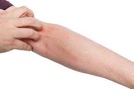 Kratze Scabies Ursachen Symptome Diagnose Behandlung Hausmittel Krank De