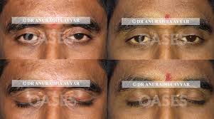 Image result for xanthelasma of eyelid