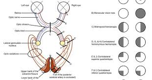 Visual Field Defects Ophthalmology Medbullets Step 2 3 Medical Knowledge Optometry Humor Sensory System