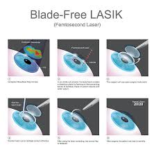 Although lasik has been performed on children as young as 16 years of age, it is good to know that the procedure is not right for children. Lasik Eye Surgery Los Angeles Laser Vision Medical Associates