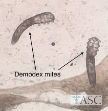 Image result for demodex rosacea