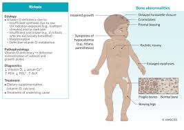 Image result for Craniotabes
