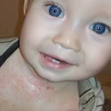 Image result for vyrážka u dětí