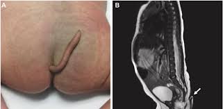 Image result for Spinal Dysraphism