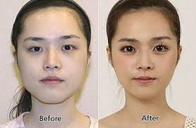 How to get plastic surgery paid for. How Do You Feel About Plastic Surgery I Use To Believe Plastic Surgery Was Dumb And People Korean Plastic Surgery Eyelid Surgery South Korean Plastic Surgery