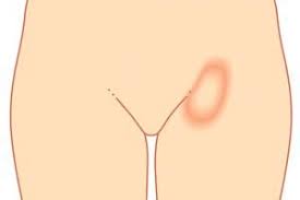 Ruang bicara (30 jun 2020)tetamudr. Hernia Inguinal Pada Bayi Baru Lahir Penyebab Gejala Diagnosis Rawatan Komprehensif Mengenai Kesihatan Di Ilive