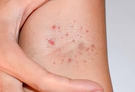 Senile purpura is benign, easy bruising that affects older adults. Petechiae In Infants Causes Symptoms Treatment Prevention
