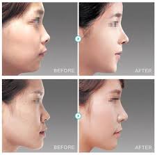 Get Attractive Looking Nose Nose Surgery Is Now More Safer And Affordable Then Ever At The Line Clinic Plastic Surgery Nose Surgery Rhinoplasty Nose Surgeon