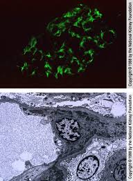 Signs and symptoms may come on suddenly or develop slowly, may be mild or severe, and may be temporary or permanent. Lupus Nephritis Genitourinary Disorders Msd Manual Professional Edition
