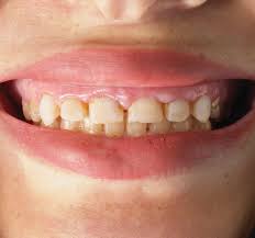 Feb 26, 2019 · in recent years, stem cell therapy has become a very promising and advanced scientific research topic. An Introduction To Aesthetic Dentistry Bdj Team