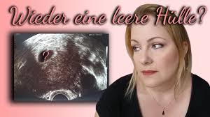 1 Ultraschall Mein Alptraum Wird Wahr 2 Ultraschall Und Der Schock Ist Gross Youtube