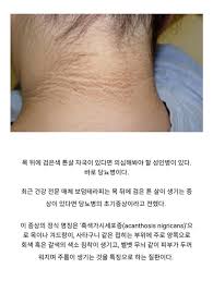 혹시 피부가 이렇다면 당뇨병 의심해봐야.jpg - Blind