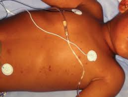 Characteristic findings on physical examination. Meningococcal Disease Dermnet Nz