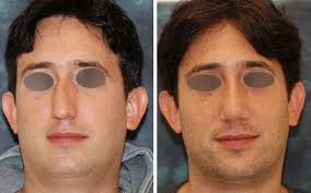 Nasal Fractures Septal Hematoma And Septal Perforation Facial Bones Plastic And Reconstructive Surgery Neck Surgery