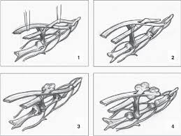 The vascular anatomy of the flexor digitorum profundus (fdp) tendon insertion is described by using a vascular injection and modified spalteholtz tissue clearing protocol in 36 human cadaver digits. Illustration Of Proposed Mechanism 1 Demonstration Of Normal Anatomy Download Scientific Diagram