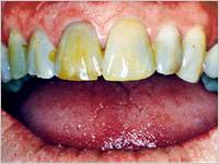 Especially in the u.s., there is less and less tolerance these days for not having when you start researching how to get rid of stained teeth, and tooth whitening, there are some new terms thrown at you. Teeth Stain Types Causes Treatments More 1 800 Dentist