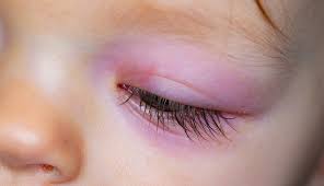 Neurodermitis An Den Augen Ursachen Symptome Behandlung