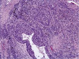 It often occurs in the lungs and lymph nodes, but it can occur in almost any organ. View Of Coal Worker S Pneumoconiosis And Sarcoid Like Reaction Mimicking Lymph Node Metastases In A Patient With Lung Cancer A Case Report The Southwest Respiratory And Critical Care Chronicles