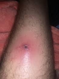 Image result for infected tick bite