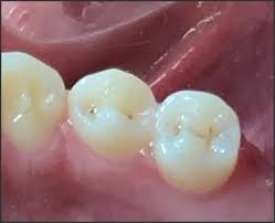 I do have fillings in about 50% of my molars but what would be a good reason not to apply sealants to the other molars? The Criteria For Selecting Teeth For Sealants Current Concepts In Preventive Dentistry Continuing Education Course Dentalcare Com
