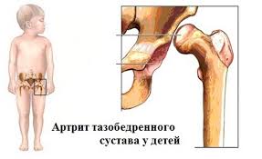 Https Xn 80axn1a Xn P1ai Artrit Tazobedrennogo Sustava U Rebenka