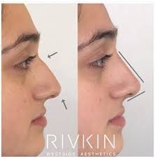Westside Aesthetics Non Surgical Nose Job Nose Job Nose Fillers Rhinoplasty Nose Jobs
