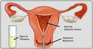 Bebek sahibi olmada güçlük çeken ve 1 yıl korunmasız ilişkiye rağmen gebe kalamayanlarda gerekli şartlar oluştuğunda intrauterin inseminasyon (aşılama) sıklıkla tercih edilen bir yöntemdir. Asilama Nasil Yapilir Antalya Kadin Dogum